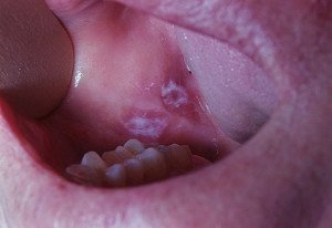 На фото пораженный эпителий полости рта вследствие развившейся лейкоплакии