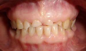 На фото зубы, утратившие значительную часть твердых тканей вследствие патологической стираемости.