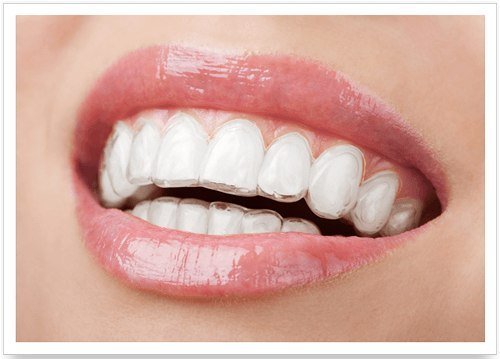 Благодаря тому, что каппу(элайнер )можно легко снять, уход за полостью рта ничем не отличается от привычной процедуры чистки зубов.