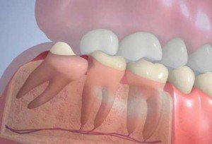 Неправильное положение зуба мудрости способно спровоцировать развитие кариеса или вызвать смещение соседних зубов.
