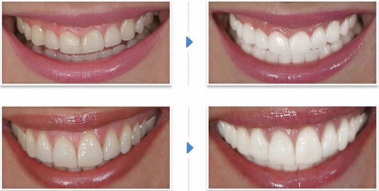 Результат отбеливания зависит от выбранного способа и индивидуальных особенностей организма. В среднем удается отбелить зубы на 3-7 тонов.