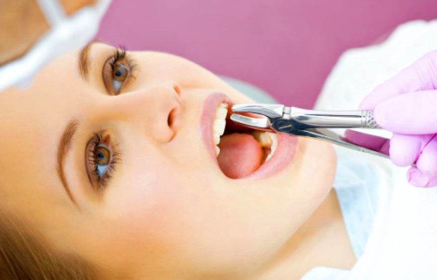 Правильный уход за полостью рта после удаления зуба в разы снижает риск воспалений и ускоряет процесс заживления лунки.