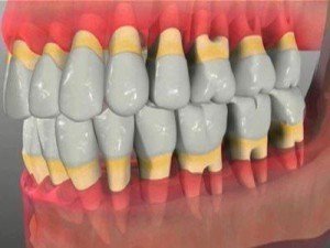 При несвоевременном лечении пародонтоза деструктивные процессы становятся необратимыми и ведут к утрате зубов.