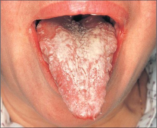 Характерным симптомом кандидозного стоматита является белый налет на слизистой оболочке полости рта.