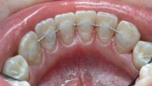 Шинирование — это стоматологическая процедура, во время которой подвижные зубы скрепляются между собой.