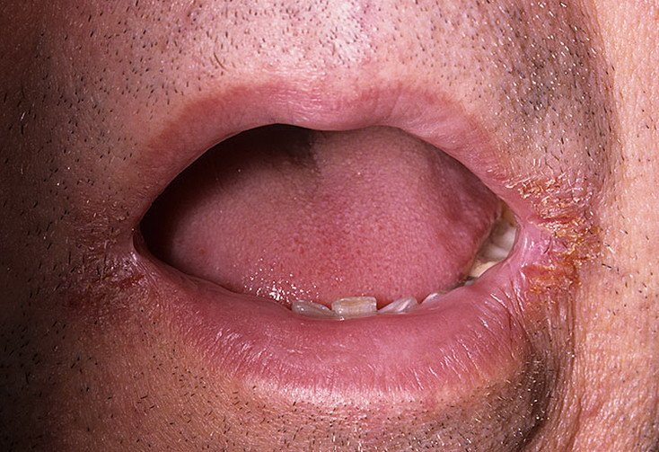 Стрептококковый ангулит характеризуется образованием гнойно-кровянистой корочки в уголке рта. 