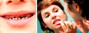 Плохое состояние зубов создает дополнительный риск травмы зубов.