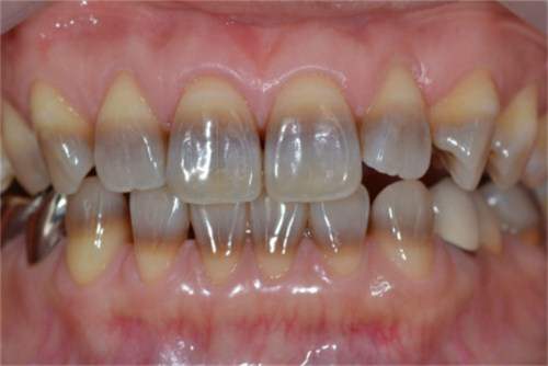 Если тетрациклиновое окрашивание зубов неравномерное, отбеливание не принесет желаемого результата. В данном случае оптимально использовать виниры.
