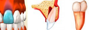 Ушибы, вывихи и переломы зубов имеют различную симптоматику.