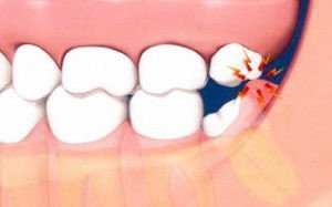 Если принято решение сохранить зуб мудрости, для снятия отека часто выполняют резекцию капюшона. Операция представляет собой удаление верхней части десны, накрывающей коронку зуба.