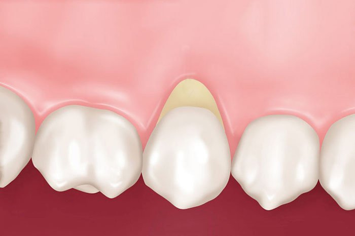 Причины возникновения и способы лечения клиновидных дефектов зубов.