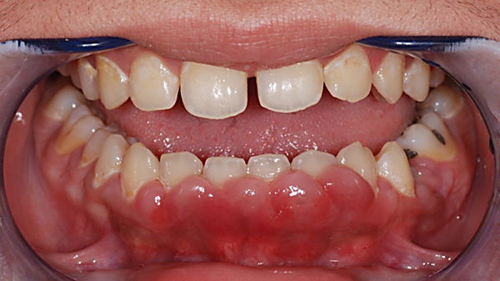 При гиперплазии десен мягкие ткани разрастаются и полностью или частично скрывают под собой коронку зуба.