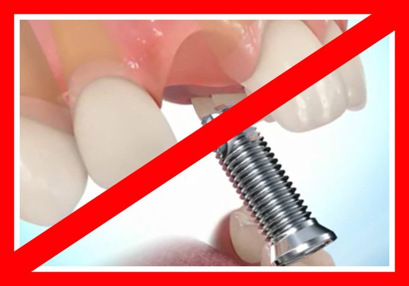 Все противопоказания к проведению имплантации зубов можно разделить на три группы — абсолютные, временные, относительные.