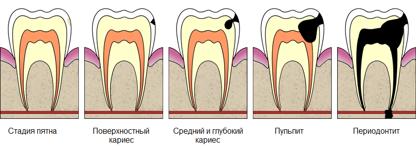 На начальной стадии развития кариес можно вылечить без препарирования. Но если заболевание запустить потеря зуба неминуема.