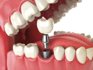 Имплантация — наиболее прогрессивная методика восстановления зубного ряда. Однако многие пациенты отказываются от лечения. Причина этого — страх. Но стоит ли бояться?