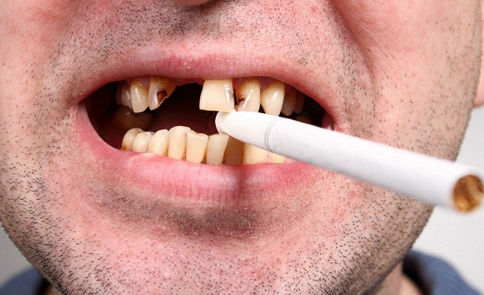 Курение табака провоцирует образование зубного камня, повышает риск возникновения кариеса, становится причиной утраты зуба.